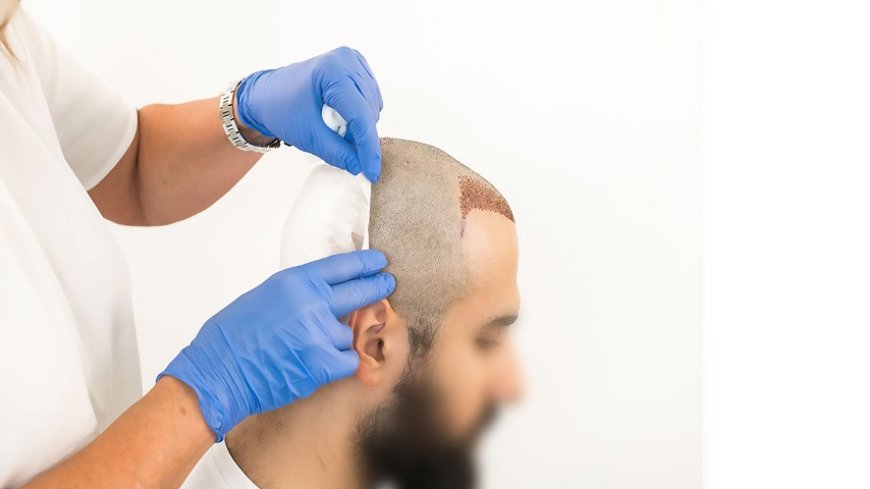 What is the Latest Technique for Hair Transplant?