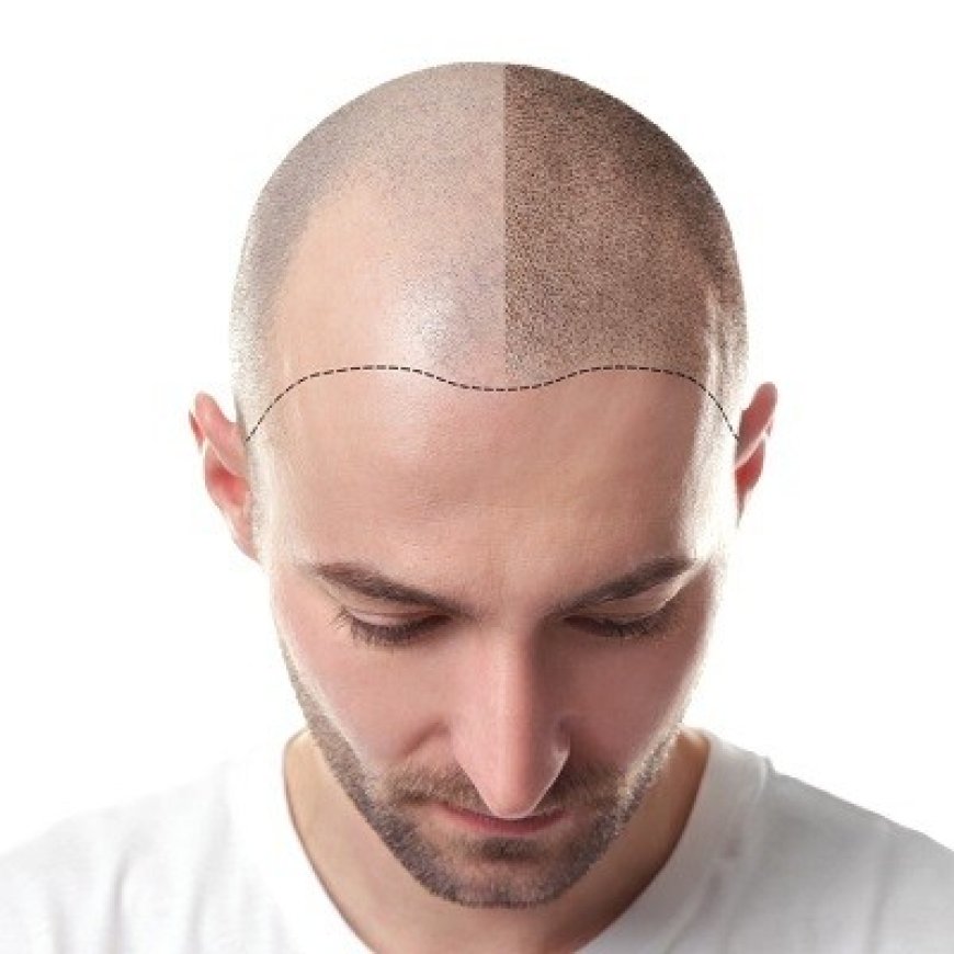 Regain Your Confidence with Hair Transplants in Islamabad