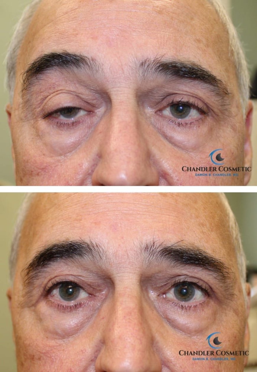 What You Should Know About the Advantages of Droopy Eyelid Surgery?