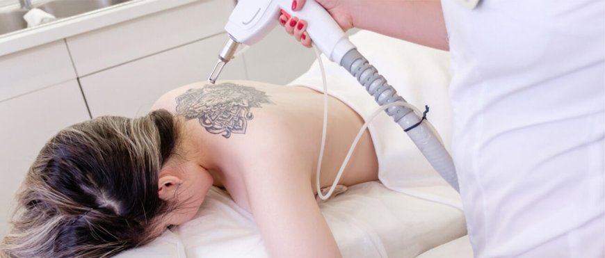 Laser Tattoo Removal in Andheri: Advanced and Effective Solutions