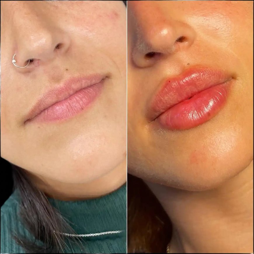 Affordable Lip Fillers by Best Doctors in Dubai