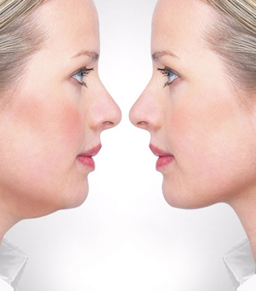 "Do’s and Don’ts After Double Chin Removal Surgery"