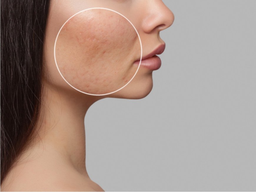 Do acne spot treatments work?