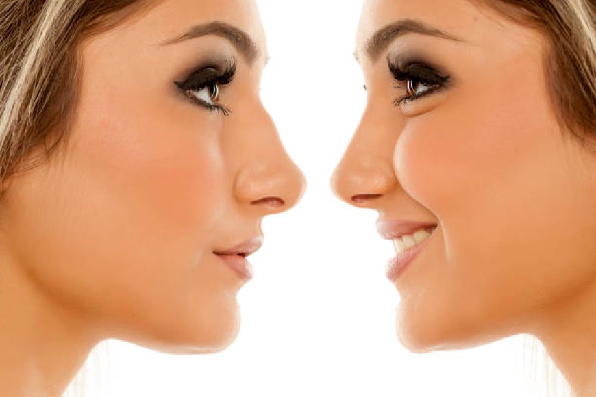 Does Rhinoplasty Affect Your Voice? Myth vs. Reality