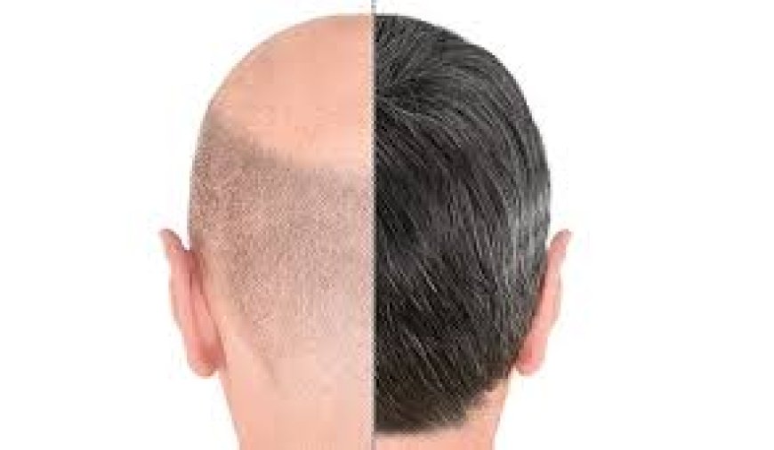 Scalp Micropigmentation vs. Hair Transplant – Pros & Cons