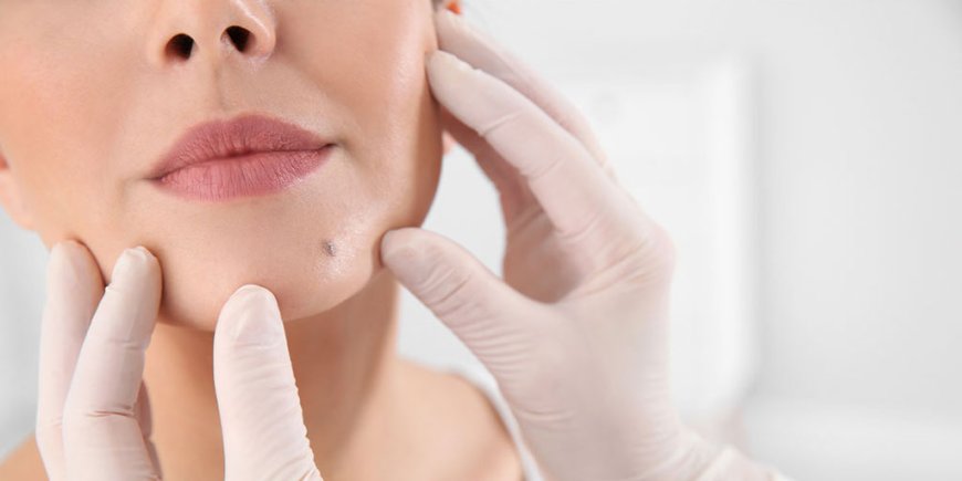 Understanding the Risks and Benefits of Mole Removal