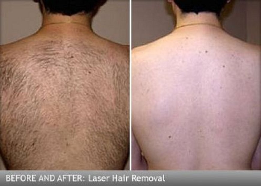 Why Laser Hair Removal is So Popular in Dubai