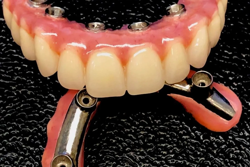 How are Fixed Dental Implant prostheses superior to Removable Ones?