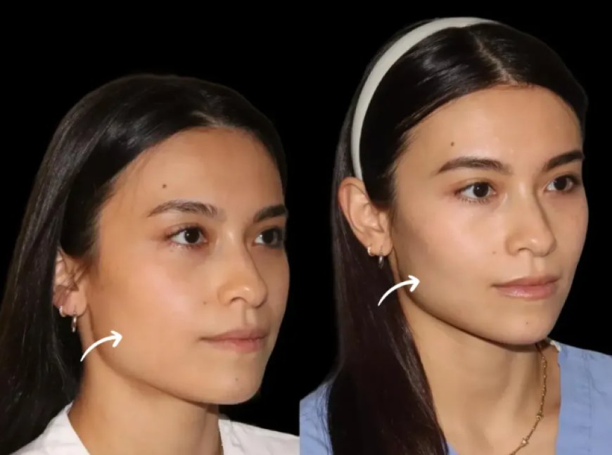 How to Verify Credentials of the Best Doctors in Dubai for Sculptra Fillers Treatments