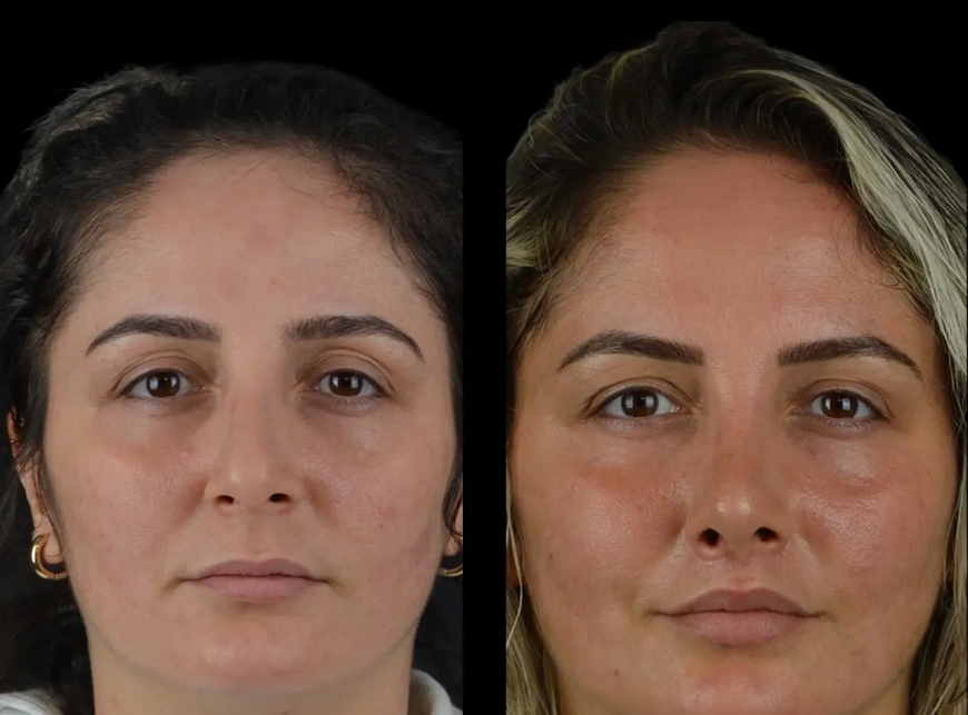 The Process of Cheek Fillers Treatments with the Best Doctors in Dubai