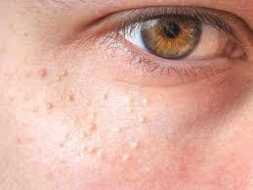 How to Remove Milia Under Eye Safely in the UK: Expert Tips & Treatments