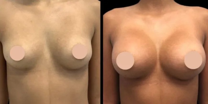 What Are the Benefits of Choosing the Best Breast Augmentation Surgeons in Dubai