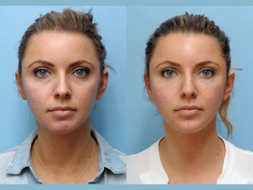 How Safe Is Thread Lift Treatment in Dubai Expert Insights