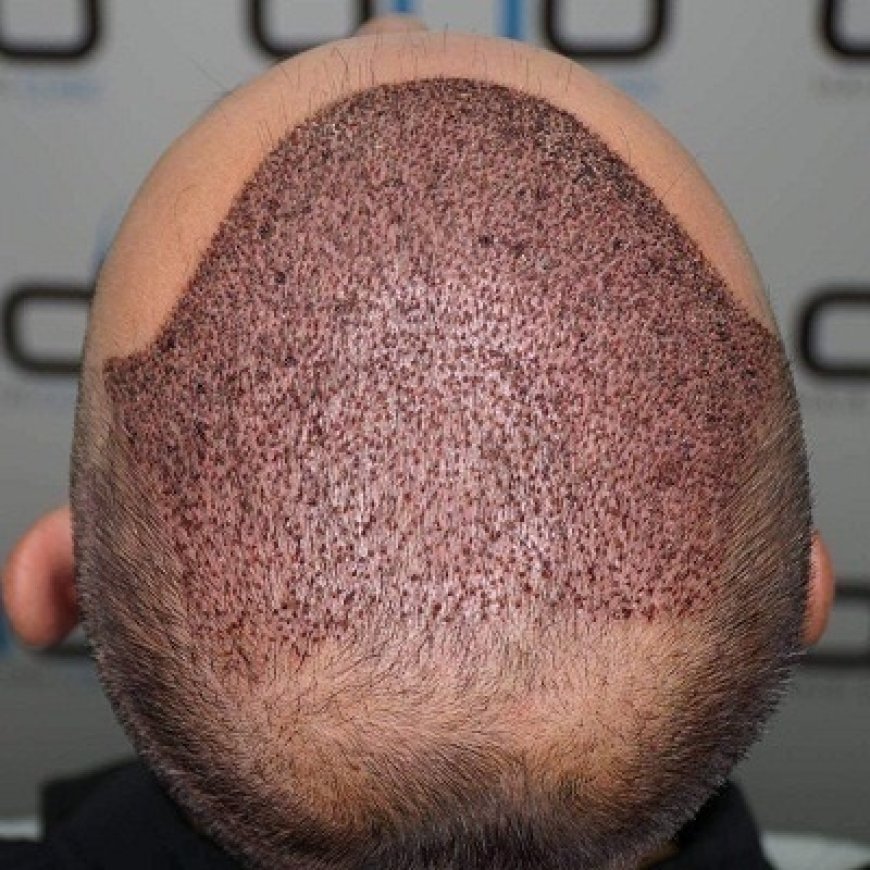 Who is a suitable candidate for a hair transplant?