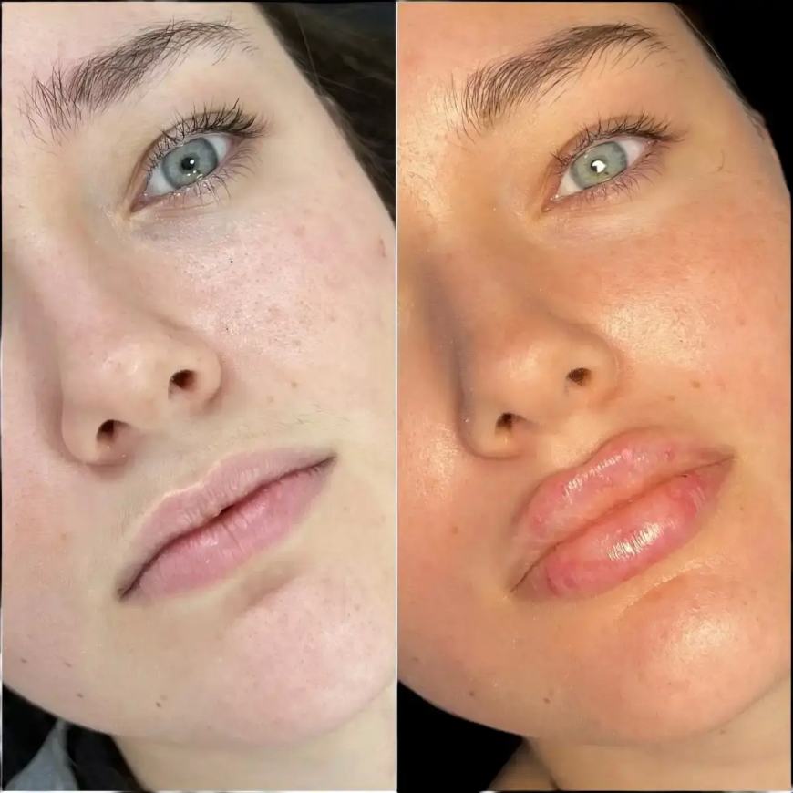 Best Doctors in Dubai for Fillers: Customized Treatments
