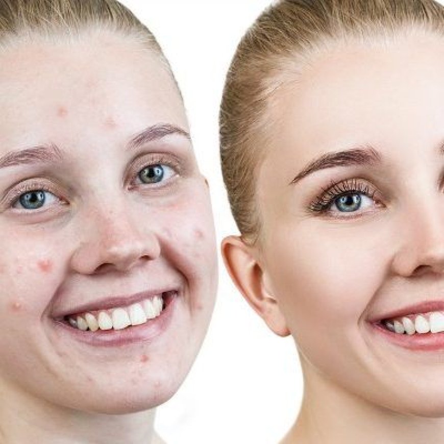 The Dangers of Using Home Remedies for Severe Acne