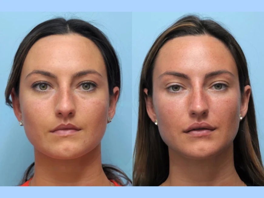 Why Thread Lift Treatment in Dubai Are Becoming a Go-To Choice for Busy Professionals