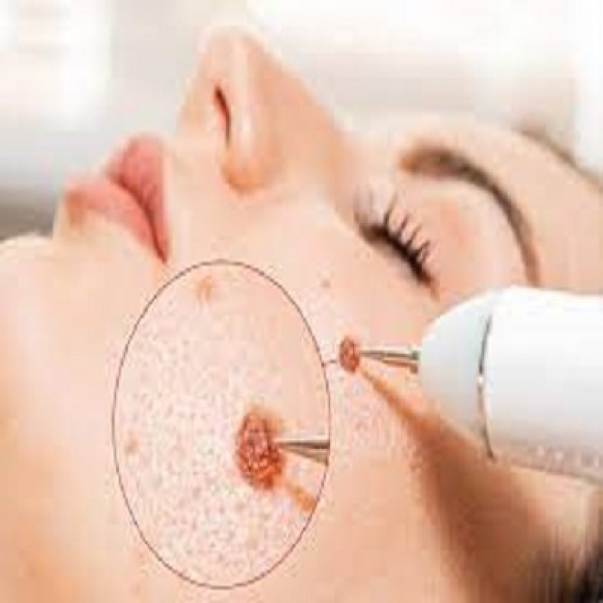 Wart Treatment During Pregnancy: What’s Safe?