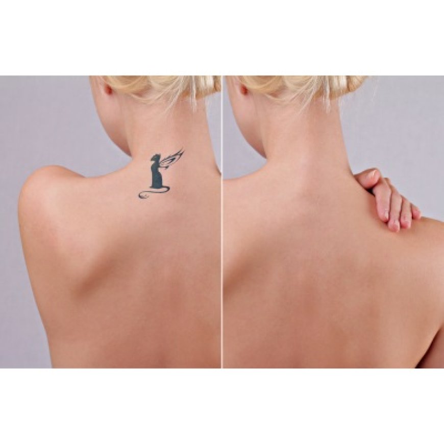 How Long Until My Tattoo Is Gone? Timeframes Explained