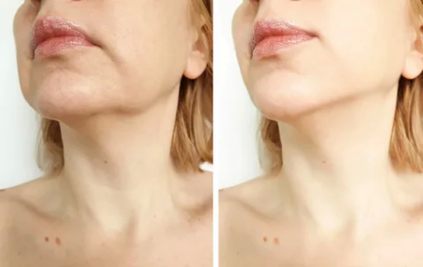 Morpheus8 in Manhattan | Real Results with Non-Surgical Skin Tightening
