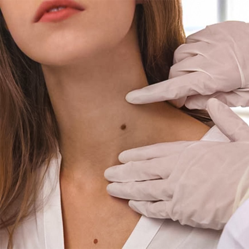 How to Care for Your Skin After Mole Removal