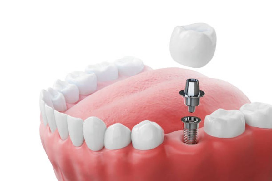 Why Dental Implants Are the Best Long-Term Solution for Tooth Loss
