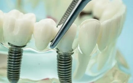 How Dental Implants Can Improve Chewing Comfort and Restore Your Smile