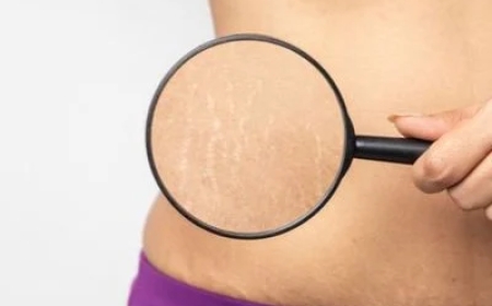 Best Stretch Marks Treatment in Pune for Smooth and Healthy Skin