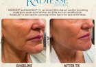 What Is Radiesse Dermal Filler and How Does It Work?