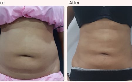 Liposuction Surgery in Delhi - Dr Rajat Gupta