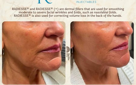 What Is Radiesse Dermal Filler and How Does It Work?