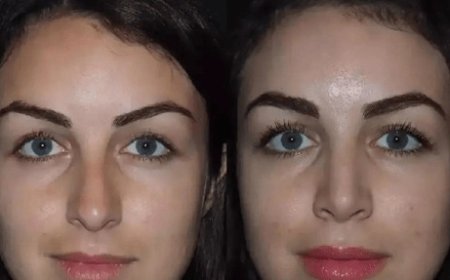 The Secrets Behind the Success of the Best Rhinoplasty Surgeon in Dubai