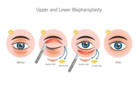 Eyelid surgery cost in Delhi - Dr Rajat Gupta
