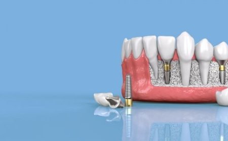 Common Myths and Facts About Dental Implants