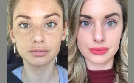 Best Doctors in Dubai for Radiofrequency (RF) Microneedling: What to Expect