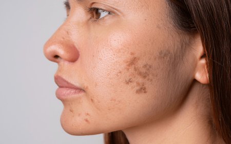 How Safe Are Laser Treatments for Pigmentation in Dubai?