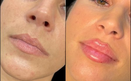Best Aesthetic Clinics in Dubai for Fillers: Advanced Facial Contouring