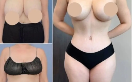 Best Tummy Tuck Surgeon in Dubai for Reliable Cosmetic Outcomes