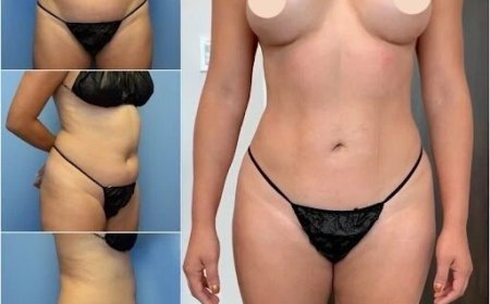 Achieve Your Dream Figure with the Best Body Contouring Surgeon in Dubai