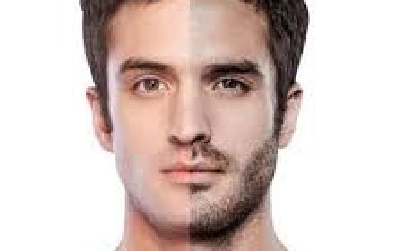 Beard Hair Transplant for Scar Coverage in Riyadh
