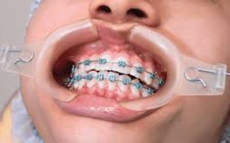 How Braces Improve More Than Just Your Smile
