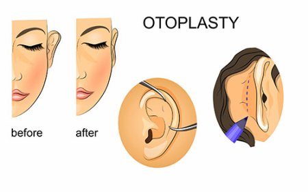 Ear Reshaping Surgery in Delhi - Dr Rajat Gupta