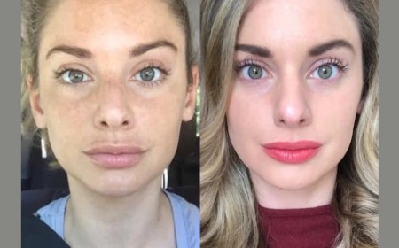 Smooth and Firm Skin with Best Plastic Surgeon in dubai for RF Microneedling