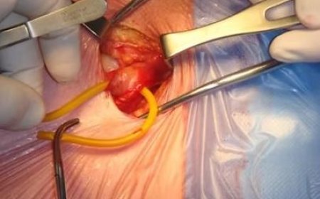Expert Hernia Surgery Singapore: Advanced Treatment for Safe and Effective Recovery