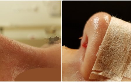 Managing Swelling and Healing After Tip Plasty in Riyadh