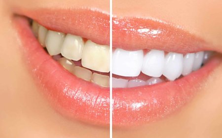 Teeth Whitening in Bikaner: Get a Brighter, More Confident Smile