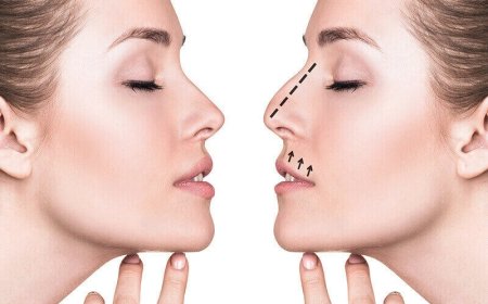 Discover Trusted Experts for Rhinoplasty in Dubai
