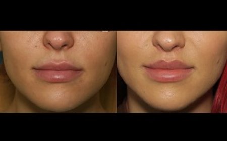 Lip Lift Surgery: A Surgical Approach to Youthful, Fuller Lips in Riyadh