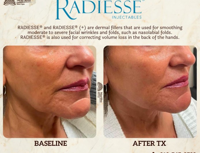 What Is Radiesse Dermal Filler and How Does It Work?