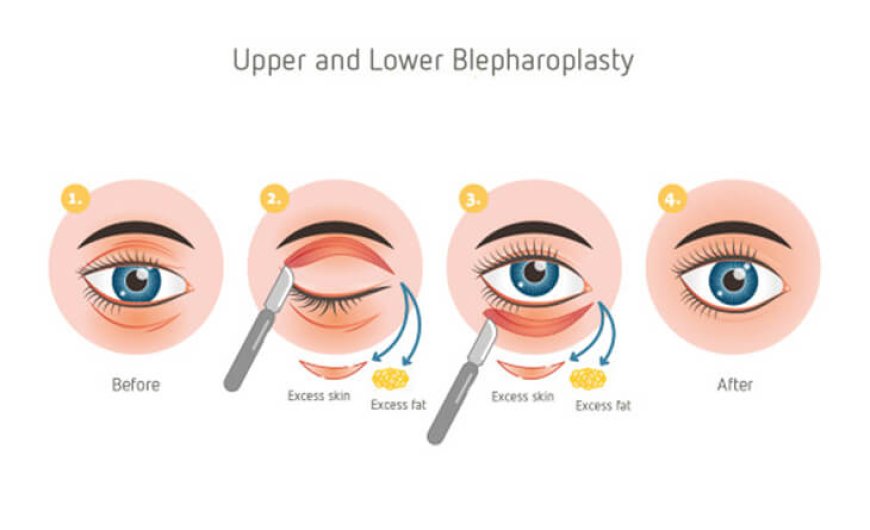 Eyelid surgery cost in Delhi - Dr Rajat Gupta
